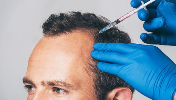 PRP hair treatment at Pharma Aesthetics
