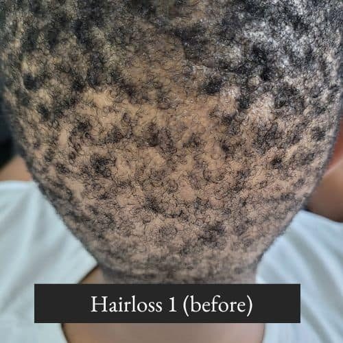 Hairloss 1 (after 9 months) (1)