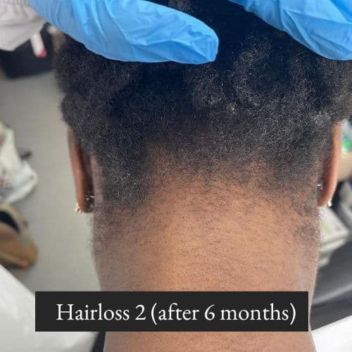 Hairloss 1 (after 9 months) (2)