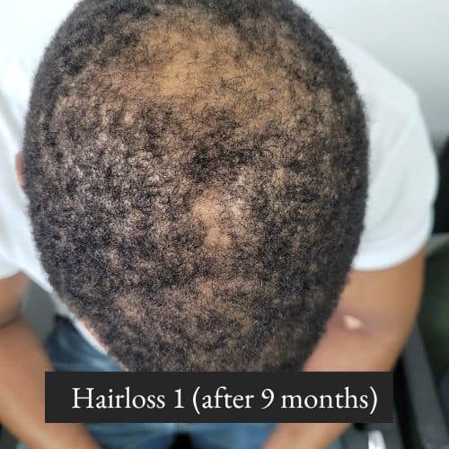 Hairloss 1 (after 9 months)
