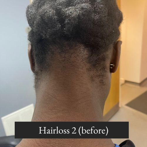 Hairloss 2 (before)