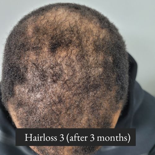 Hairloss 3 (after 3 months)