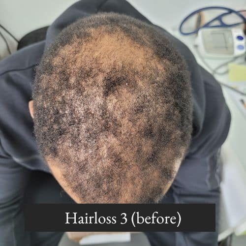 Hairloss 3 (before)