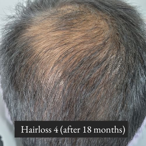 Hairloss 4 (after 18 months)