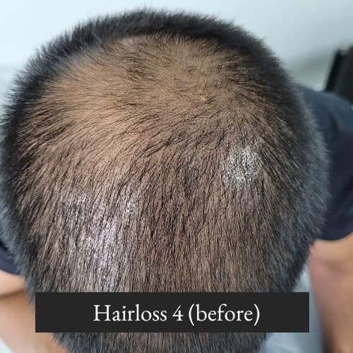Hairloss 4 (before)