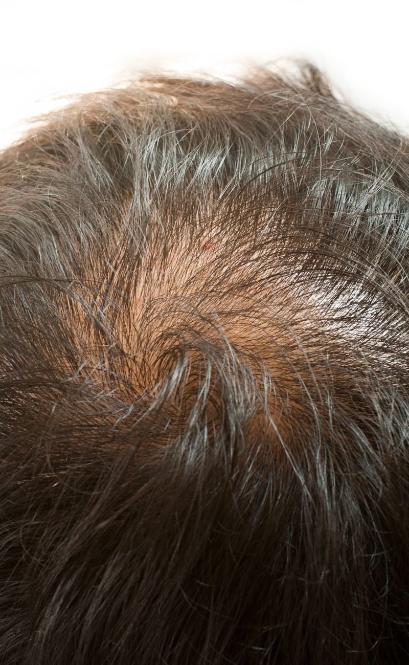Hairloss Treatment Pharma Aesthetics