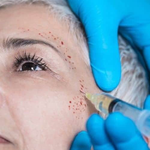 Platelet-Rich Plasma Treatment Essex